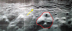 Another DSL-120 sonar record that is 500 m from top to bottom. The yellow arrow points to the shallow summit trough about 50 meters wide in places that runs along the East Pacific Rise axis. The trough is discontinuous and tapers to an end near the left side of this image. The red line outlines a small field of 4 volcanic cones.